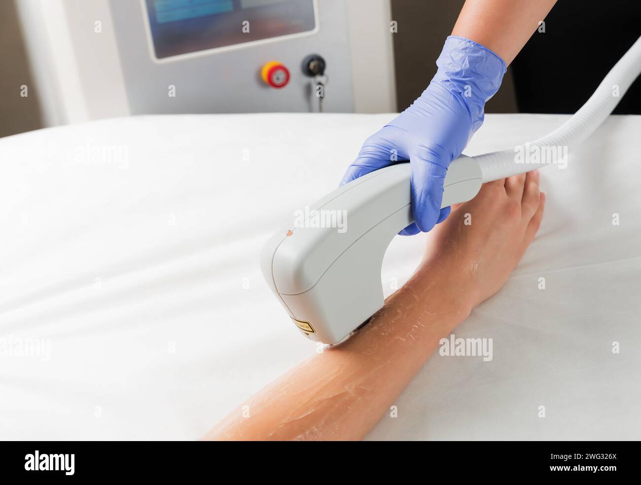 Rimozione laser dei peli delle mani in un salone di bellezza con tecnologia di epilazione laser. Foto Stock
