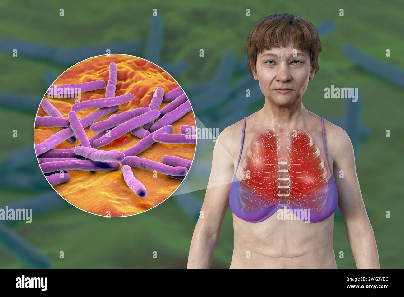 Illustrazione che mostra una paziente con pelle trasparente, che rivela i polmoni affetti da tubercolosi miliare e primo piano di Mycobacterium tuberc Foto Stock