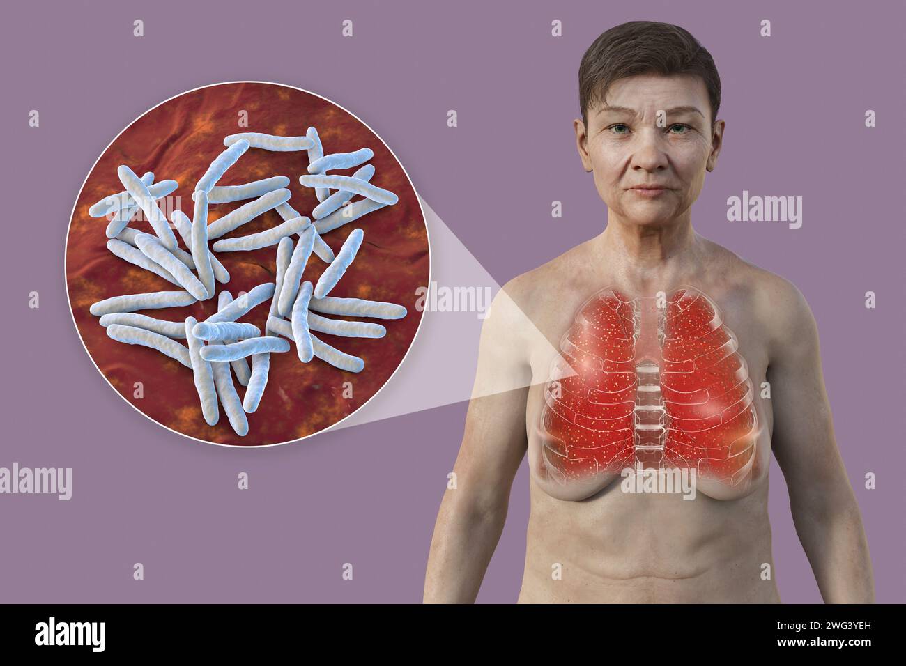Donna con tubercolosi miliare polmonare, illustrazione Foto Stock