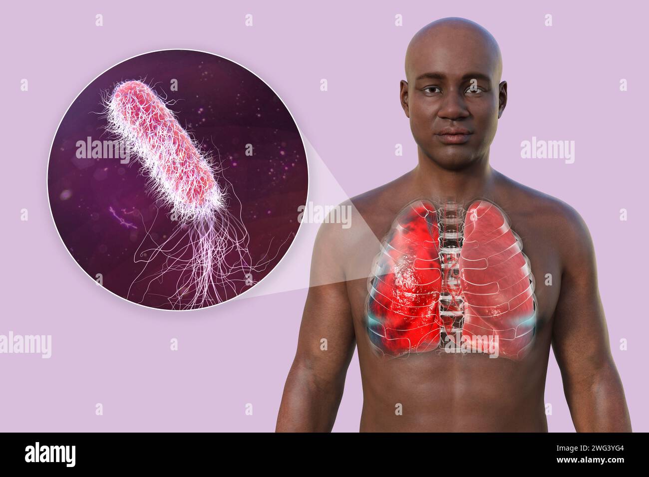 Uomo con polmoni affetti da polmonite, illustrazione Foto Stock