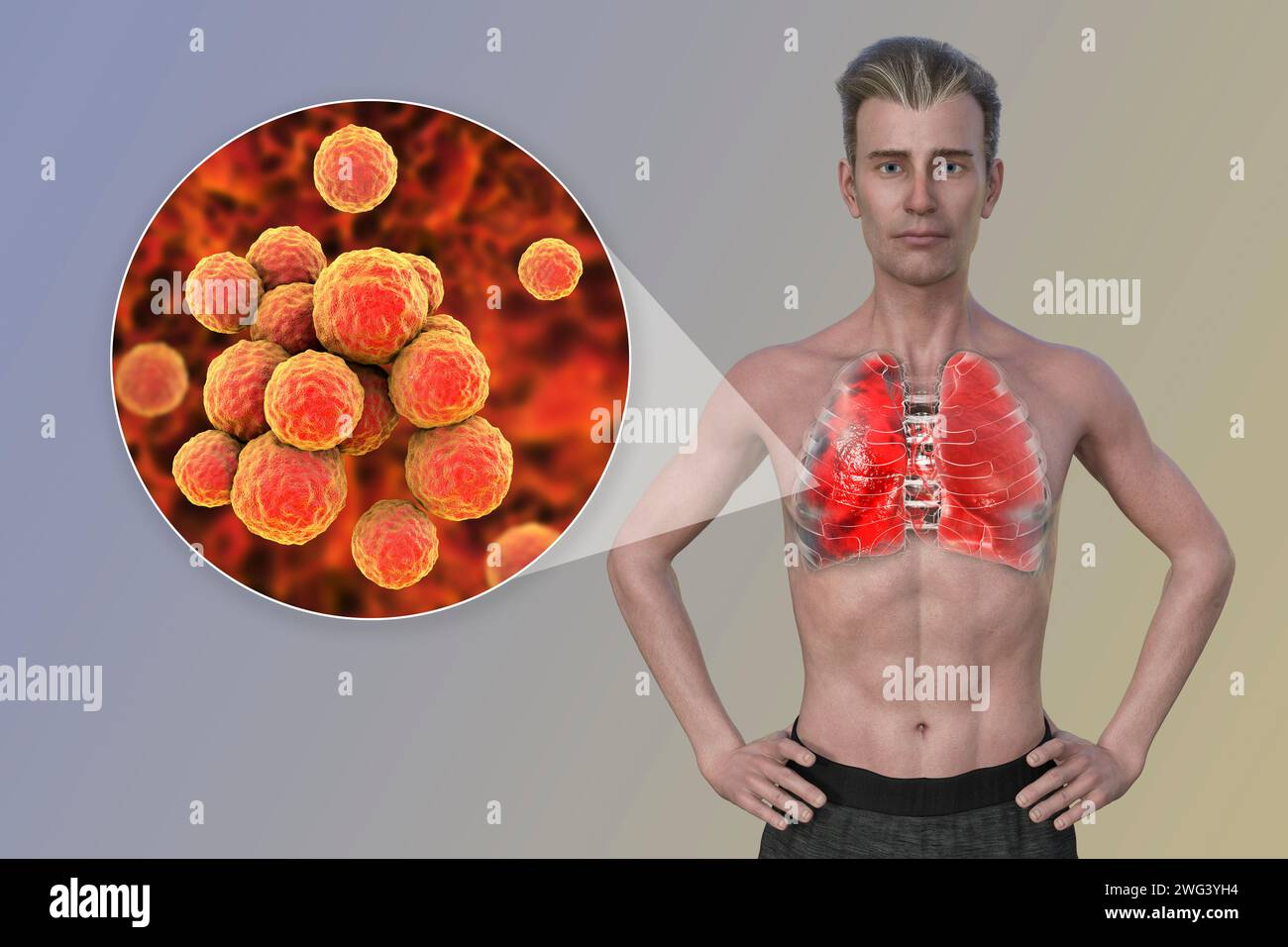 Uomo con polmoni affetti da polmonite, illustrazione Foto Stock