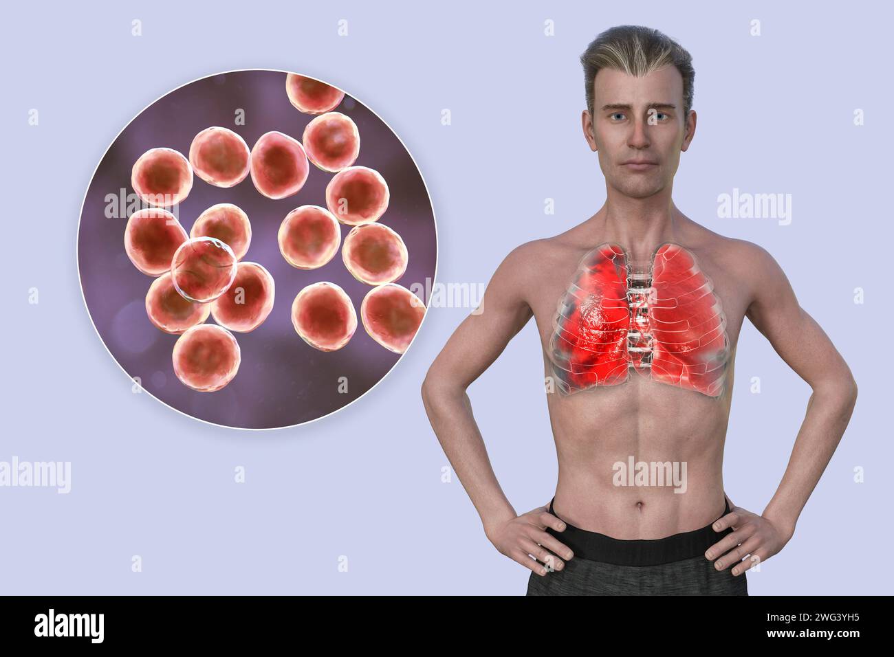 Uomo con polmoni affetti da polmonite, illustrazione Foto Stock