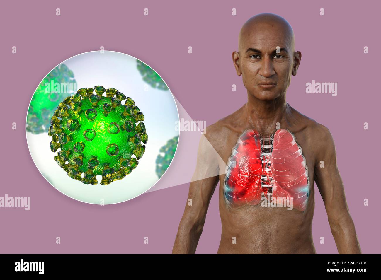 Uomo con polmoni affetti da polmonite, illustrazione Foto Stock