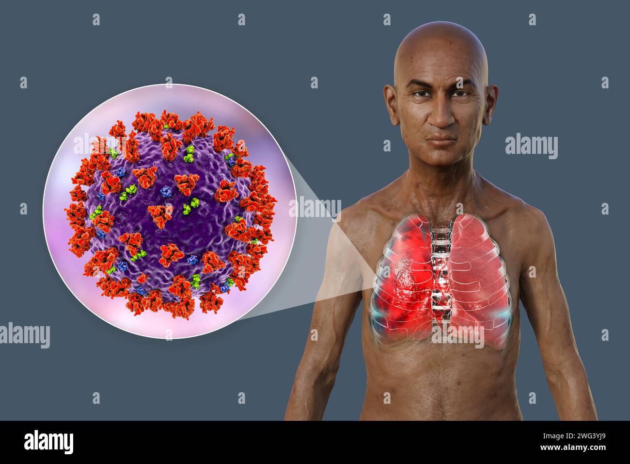 Uomo con polmoni affetti da polmonite, illustrazione Foto Stock