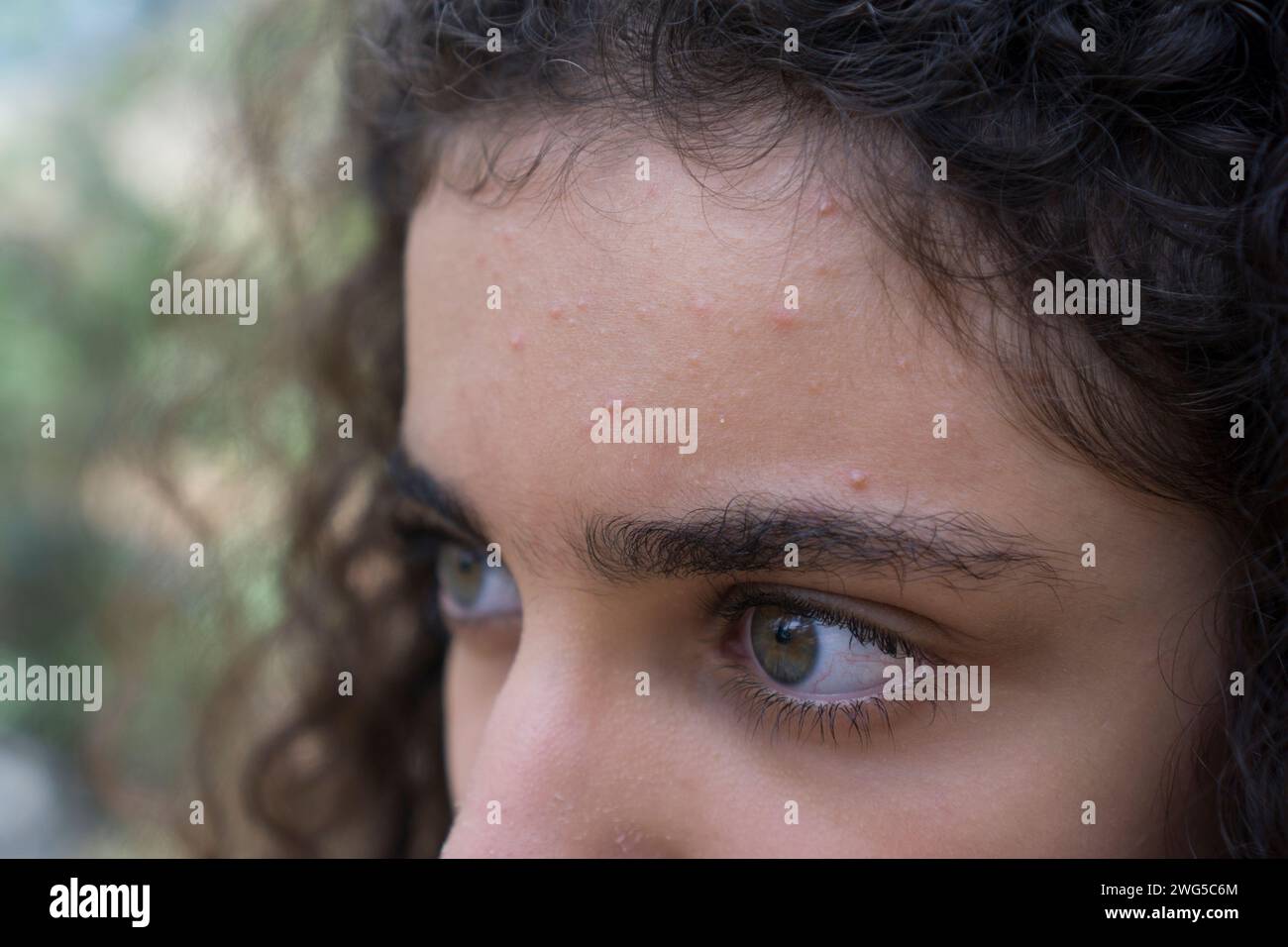 Primo piano di una ragazza mediorientale con l'acne sulla fronte che guarda lontano Foto Stock