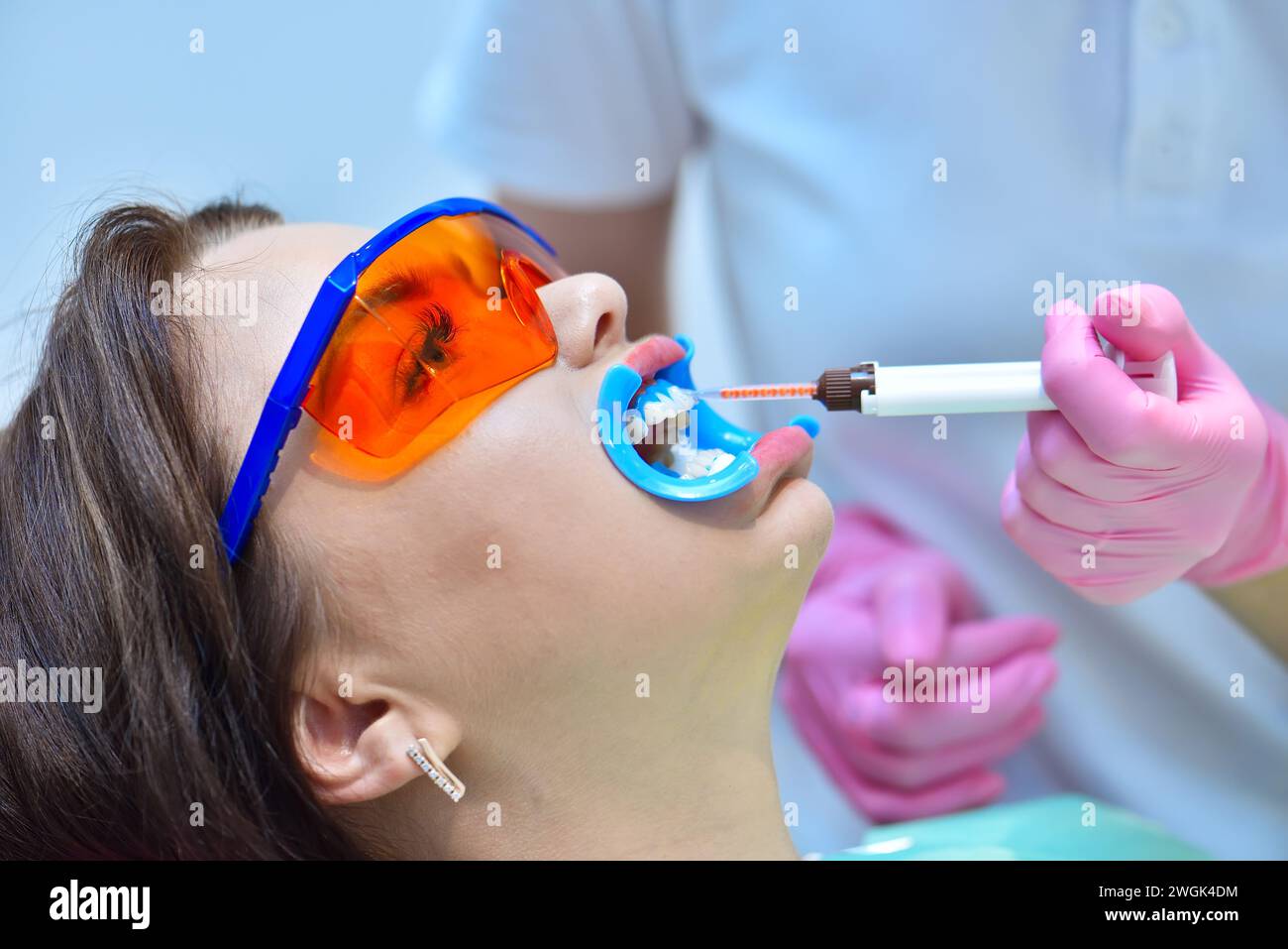 Il dentista con guanti rosa applica il gel sbiancante ai denti del paziente in clinica odontoiatrica. Sbiancamento dei denti in un concetto di clinica odontoiatrica. Primo piano Foto Stock