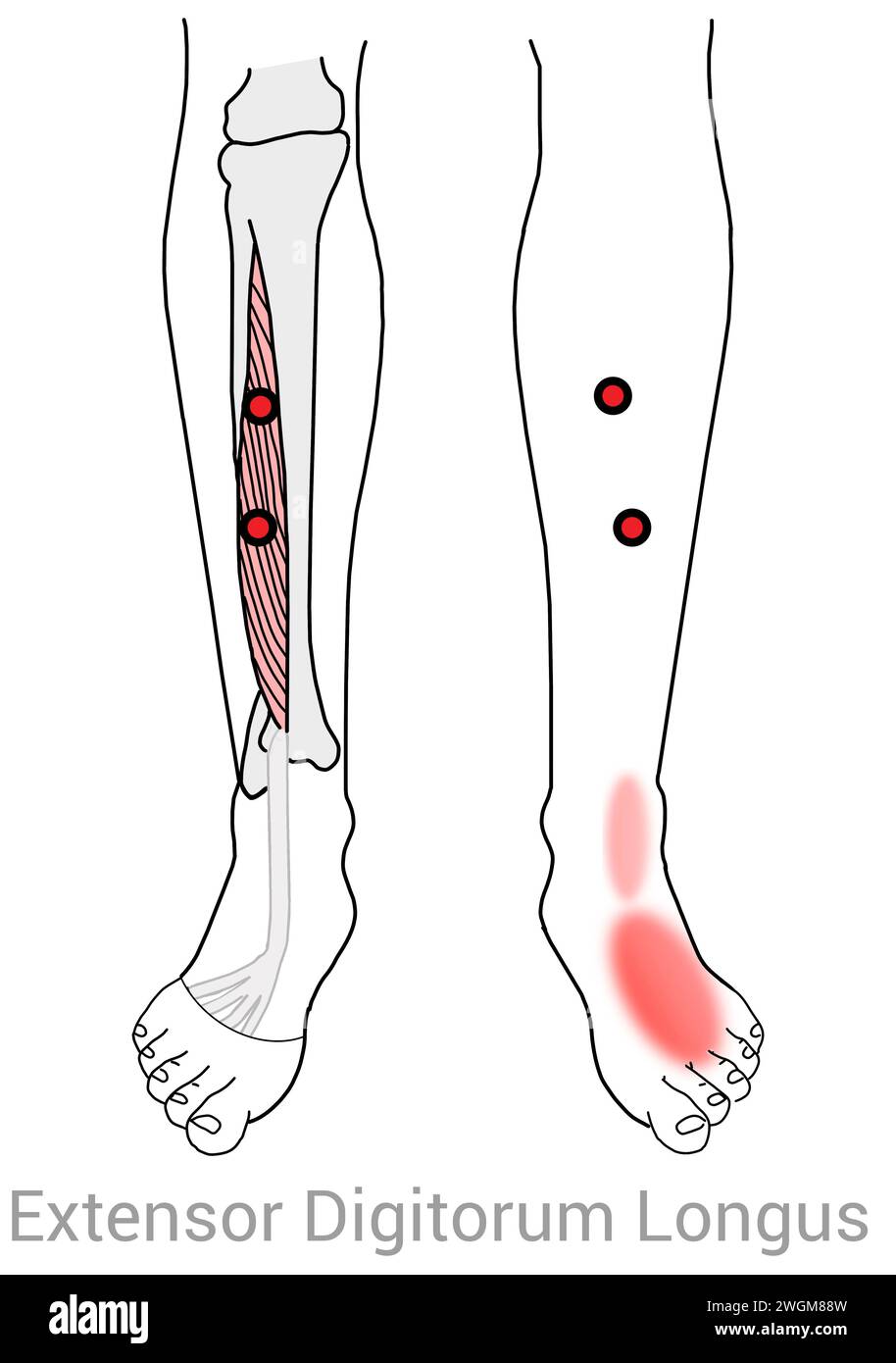Extensor Digitorum Longus: Punti di attivazione miofasciale che causano dolore lungo lo stinco nella caviglia e nel piede, oltre ad altre posizioni di dolore associate Foto Stock