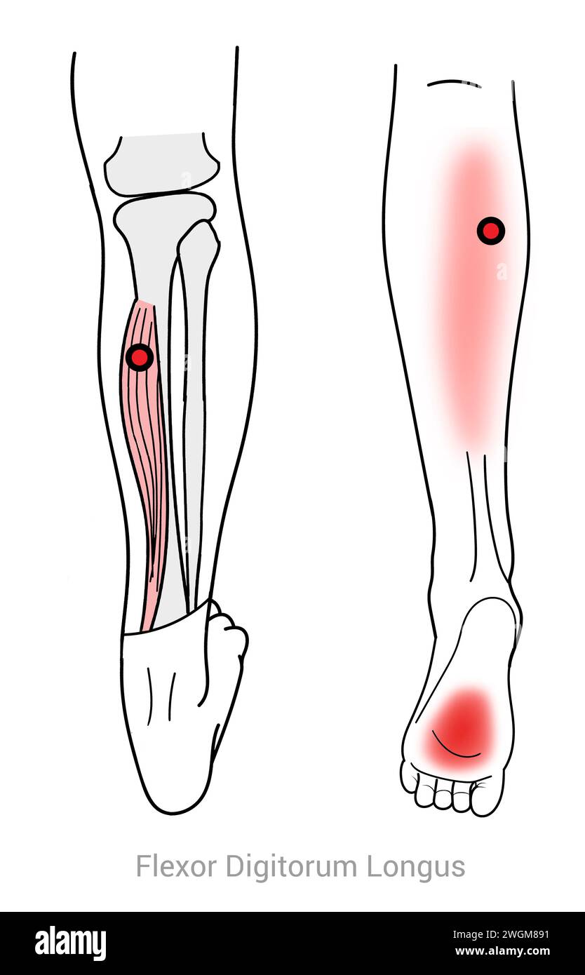 Flessore Digitorum Longus: Punti di attivazione miofasciale che causano dolore al polpaccio nel piede e altre posizioni di dolore associate Foto Stock