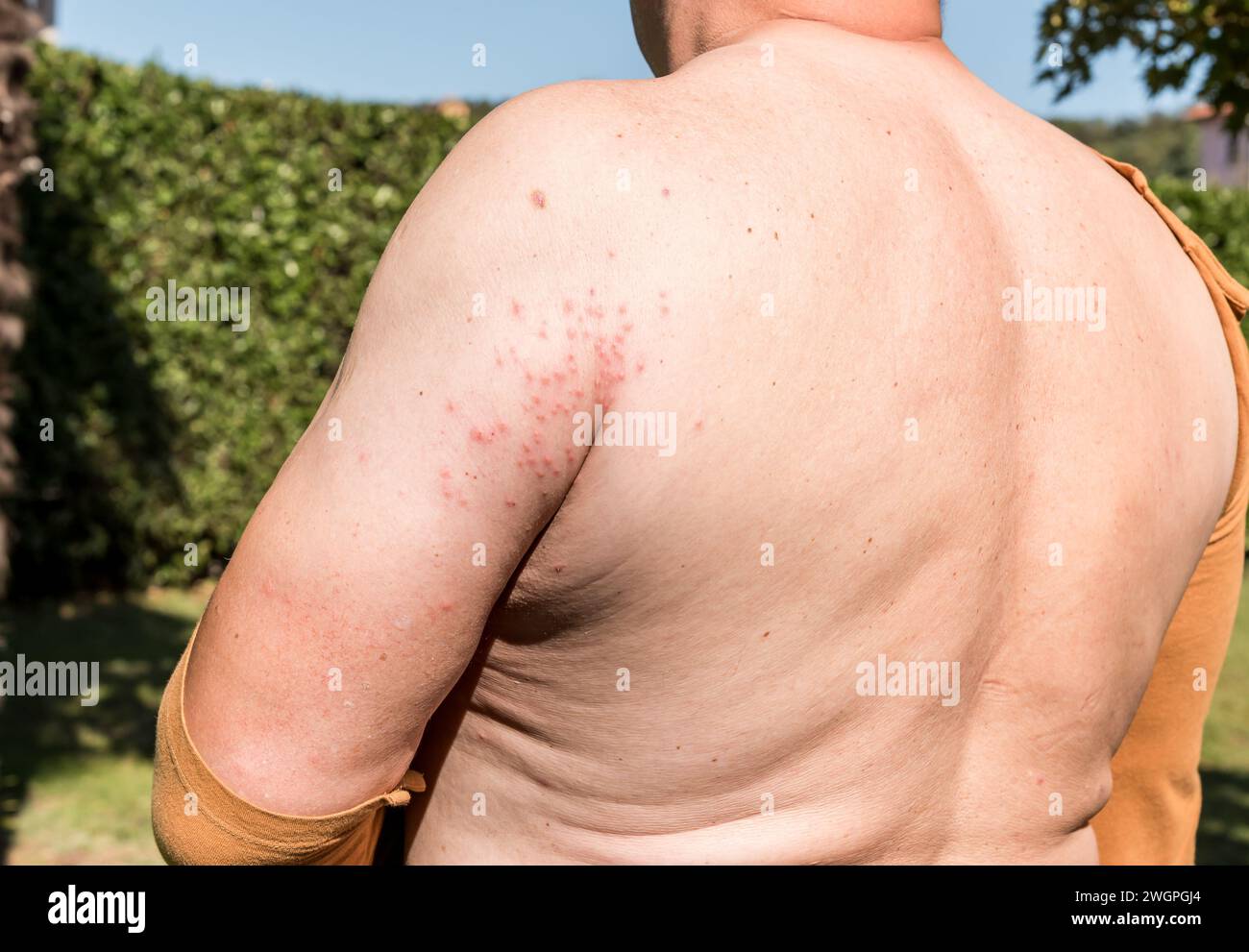 Il braccio dell'uomo con eruzione cutanea, sintomi di prurito, allergia cutanea. Foto Stock