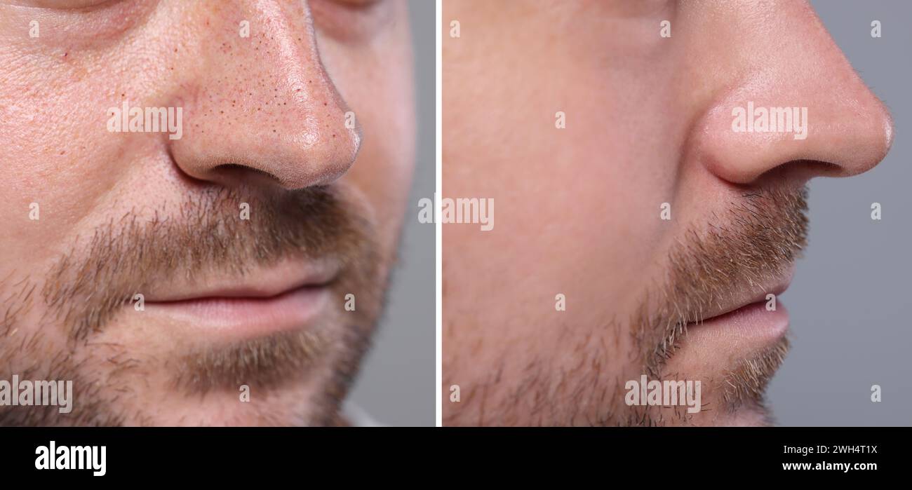 Trattamento Blackhead, prima e dopo. Collage con foto di uomo su sfondo grigio, vista primo piano Foto Stock