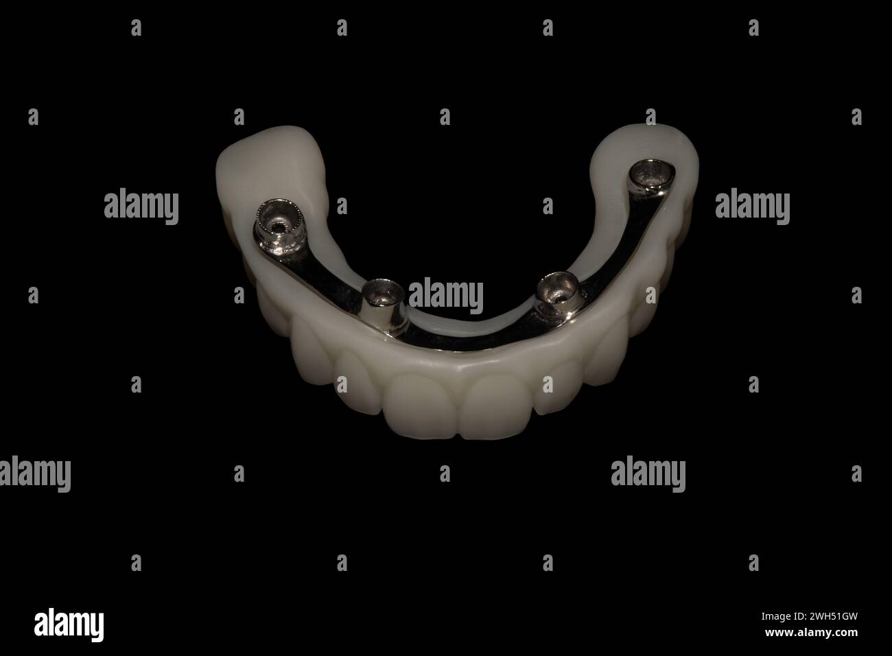 Protesi ibrida: Impianti dentali con barra in metallo e struttura stampata in 3D. Foto Stock