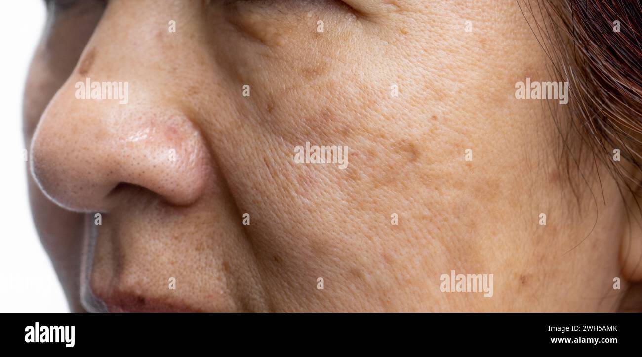 Le donne in menopausa si preoccupano del melasma sul viso. Foto Stock