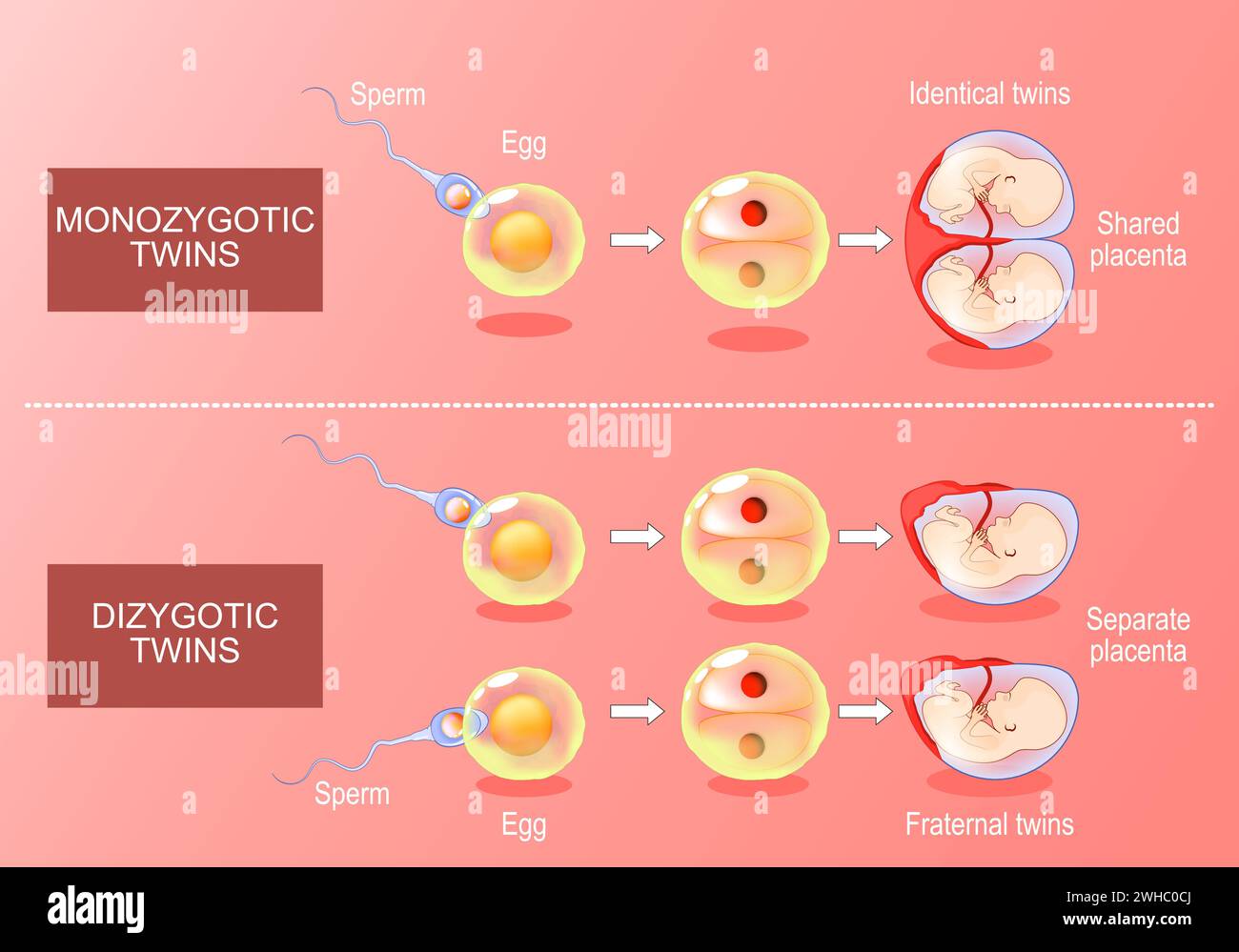 Sviluppo di Zygote in gemelli monozigotici e dizigotici. Dalla fecondazione, l'uovo e lo sperma alla formazione di sacchi amniotici. Vettore isometrico. Illustrazione piatta Illustrazione Vettoriale