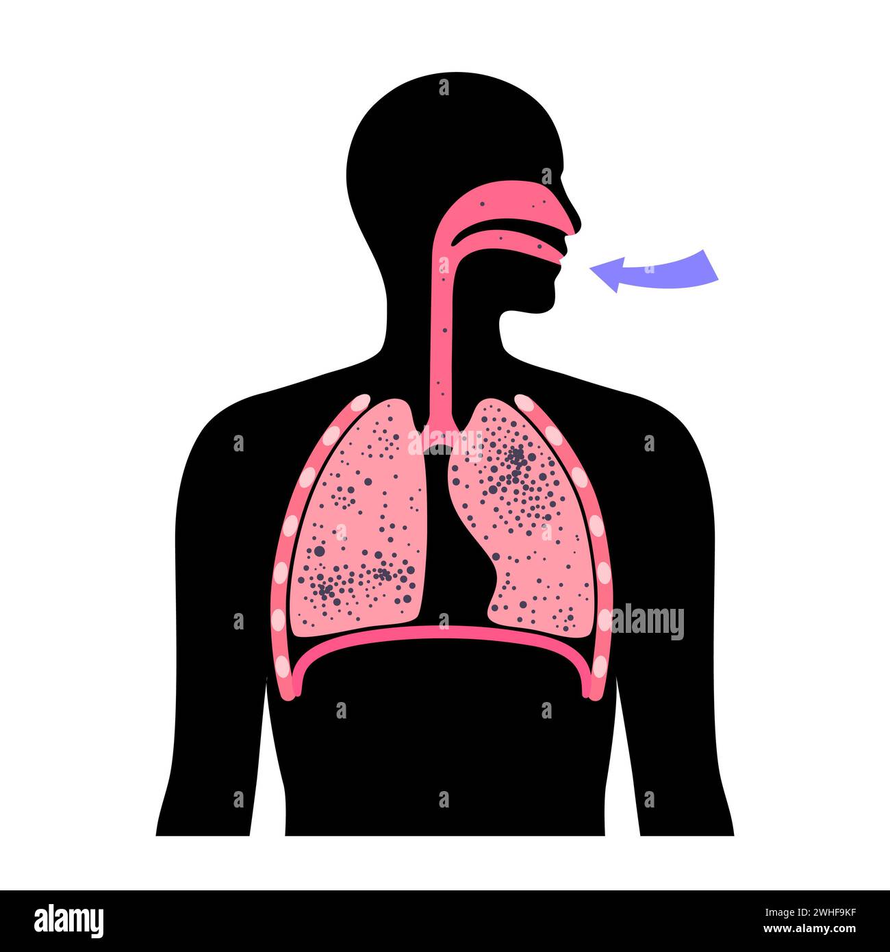 Pneumoconiosi malattia polmonare, illustrazione Foto Stock