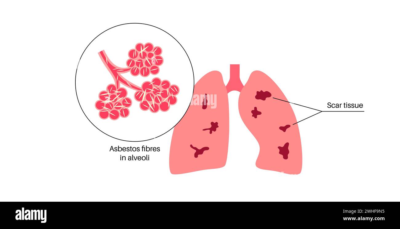 Asbestosi malattia polmonare, illustrazione Foto Stock