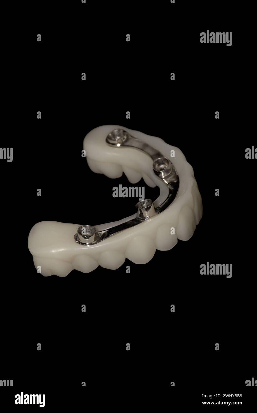 Protesi ibrida: Impianti dentali con barra in metallo e struttura stampata in 3D. Foto Stock