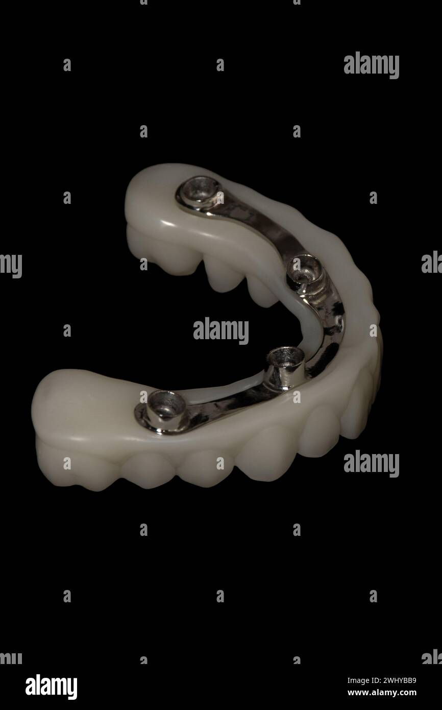 Protesi ibrida: Impianti dentali con barra in metallo e struttura stampata in 3D. Foto Stock