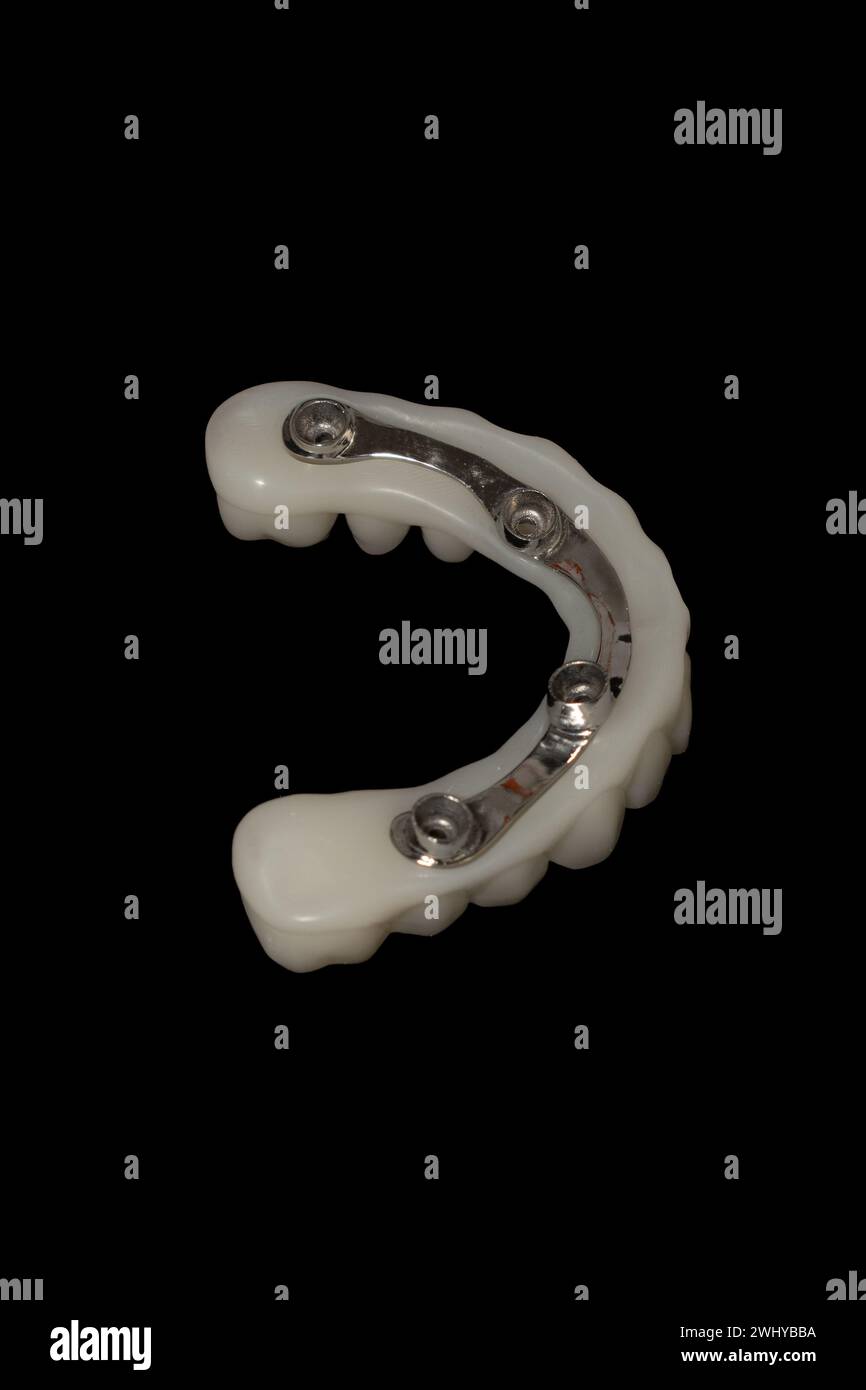 Protesi ibrida: Impianti dentali con barra in metallo e struttura stampata in 3D. Foto Stock