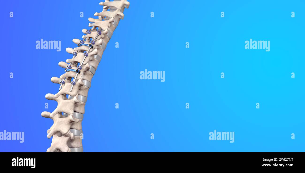 Illustrazione medica 3D della fusione toracica posteriore con viti e aste per pedicle su uno scheletro umano Foto Stock