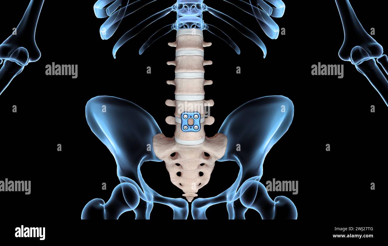 Illustrazione medica 3D di fissaggio ortopedico della colonna vertebrale fissaggio anteriore della piastra lombare anteriore su scheletro umano Foto Stock