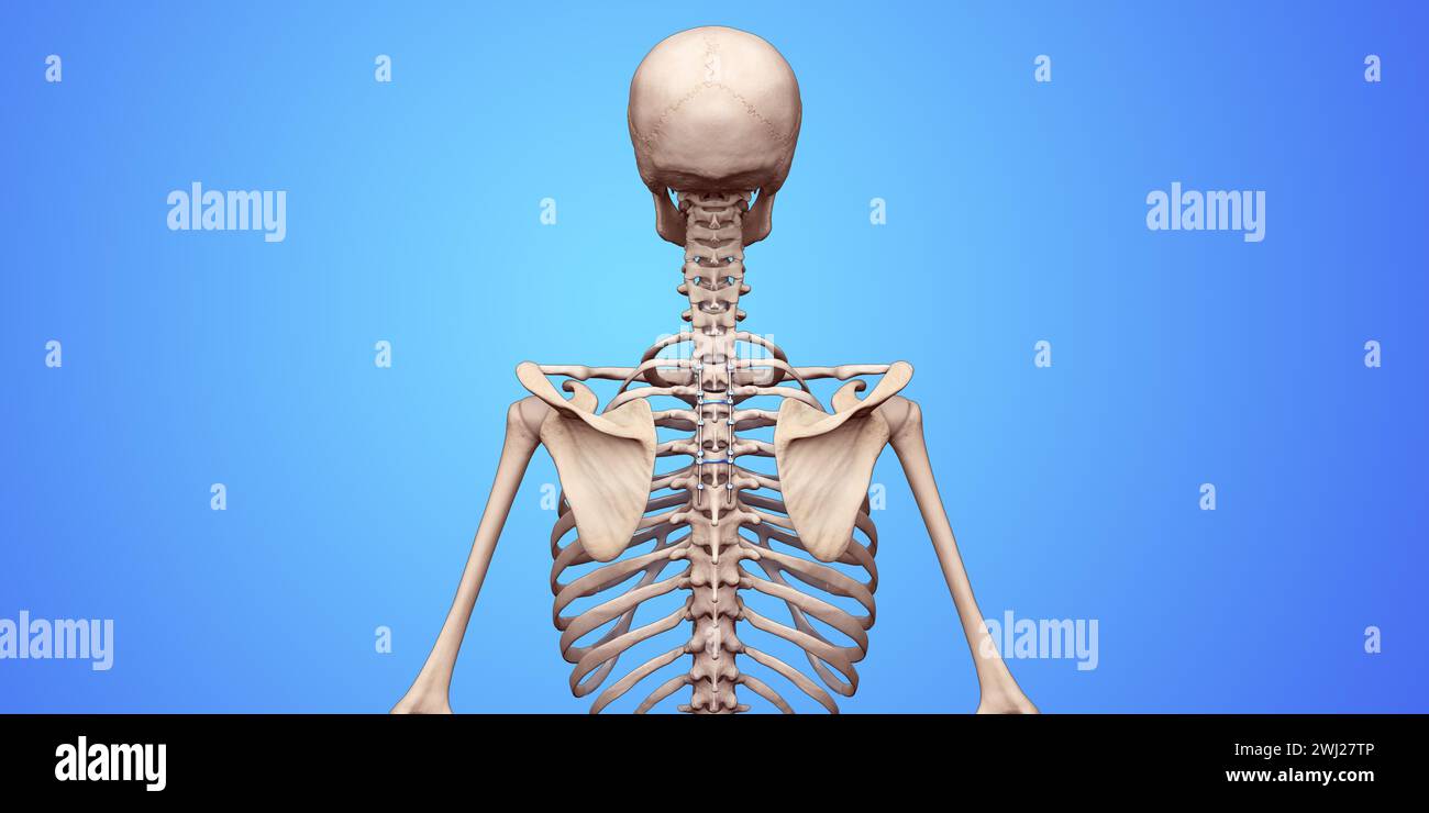 Illustrazione medica 3D della fusione toracica posteriore con viti e aste per pedicle su uno scheletro umano Foto Stock