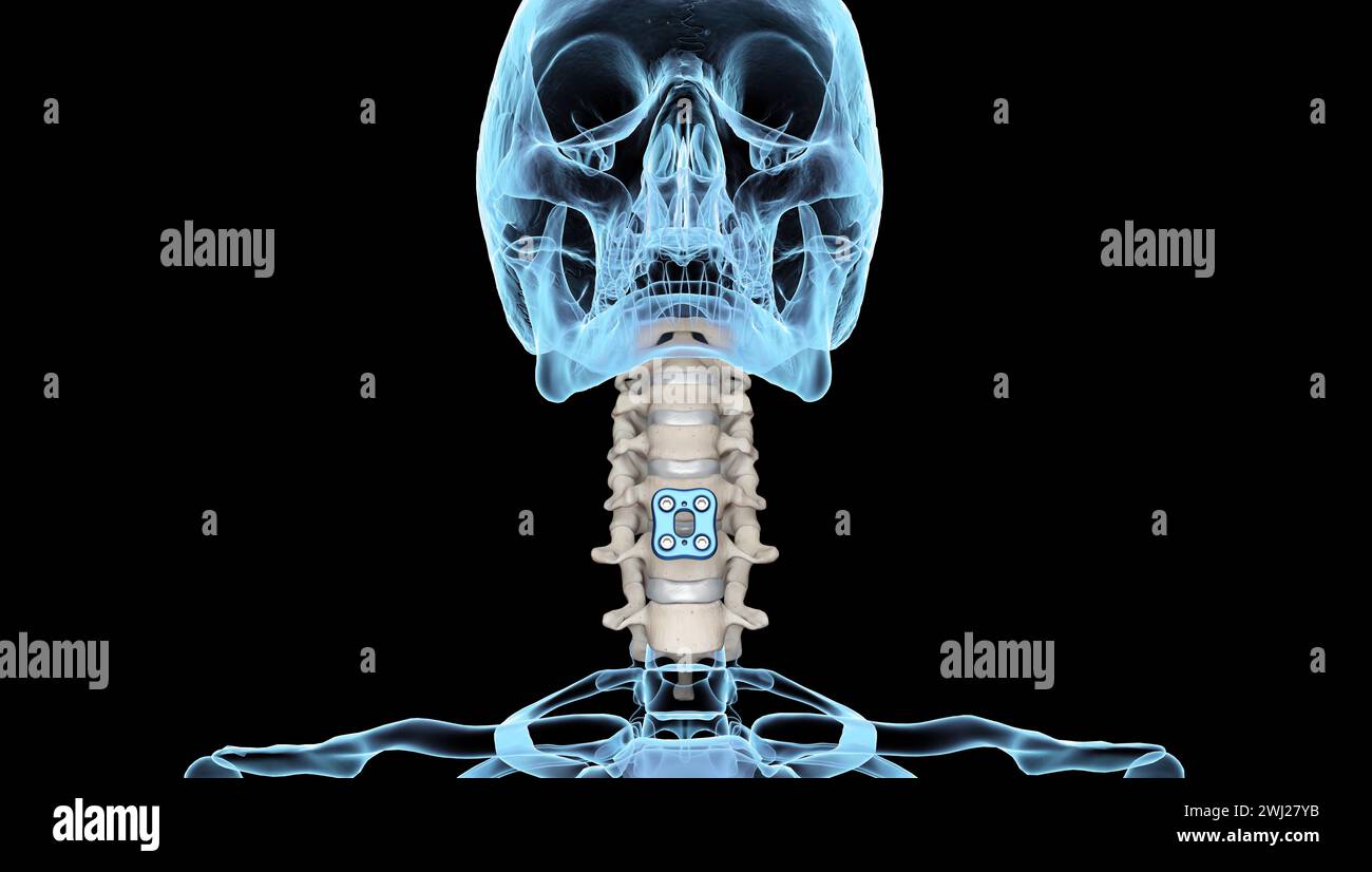 Illustrazione medica 3D della fissazione ortopedica della colonna vertebrale fissatore anteriore della piastra cervicale anteriore su uno scheletro umano Foto Stock