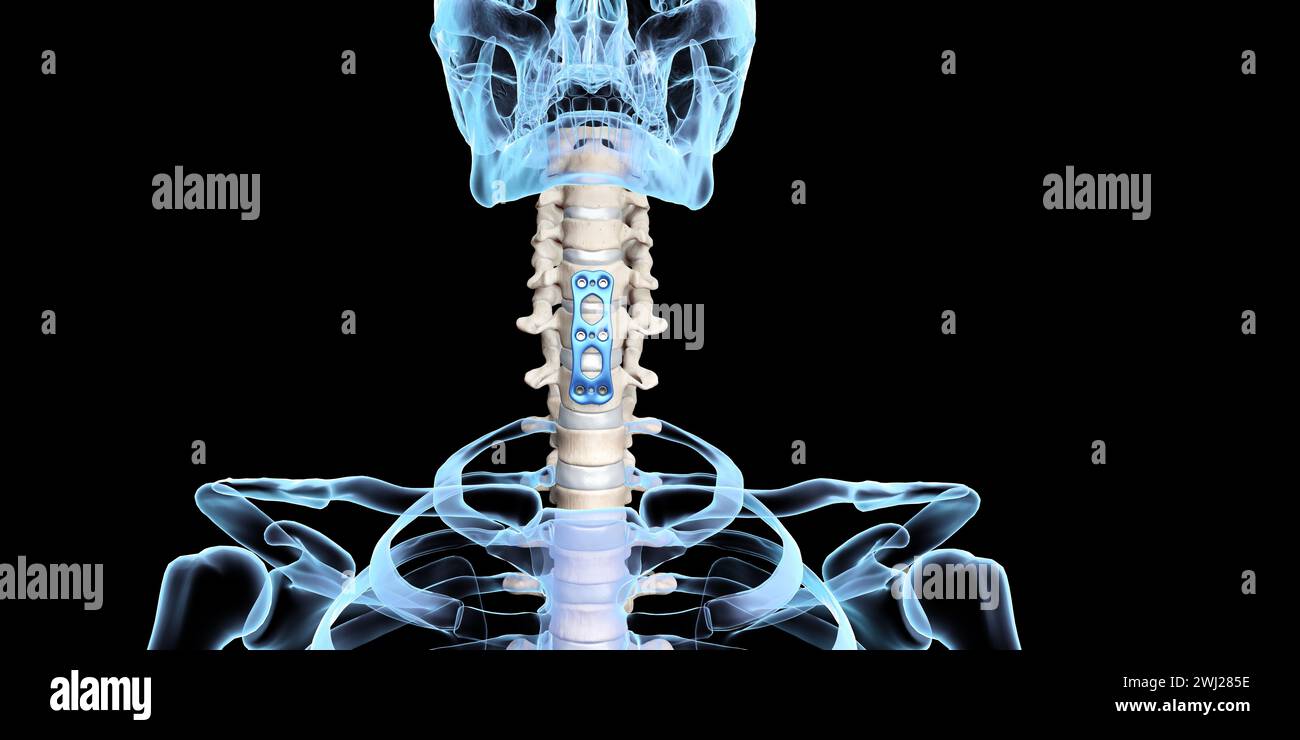 Illustrazione medica 3D della fissazione ortopedica della colonna vertebrale fissatore anteriore della piastra cervicale anteriore su uno scheletro umano Foto Stock