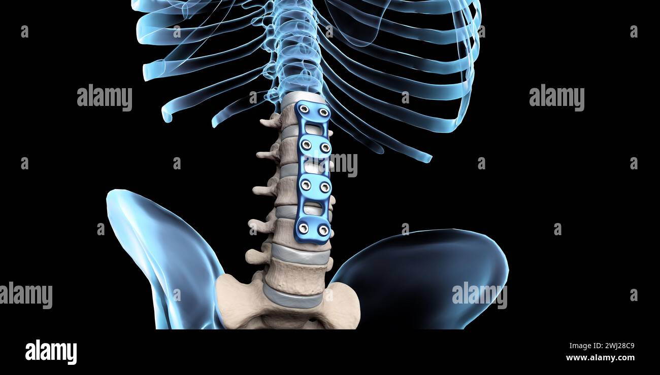 Illustrazione medica 3D di fissaggio ortopedico della colonna vertebrale fissaggio anteriore della piastra lombare anteriore su scheletro umano Foto Stock
