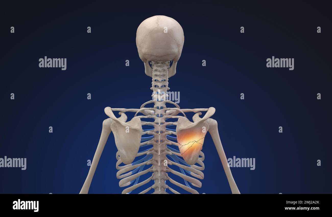 d illustrazione di uno scheletro umano con lesione della scapola rotta Foto Stock