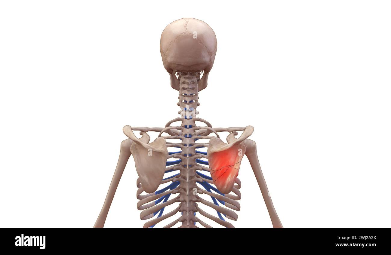 d illustrazione di uno scheletro umano con lesione della scapola rotta Foto Stock