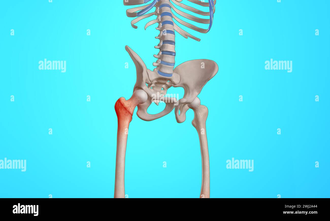 Frattura intertrocanterica sullo scheletro della testa del femore illustrazione medica 3D. Foto Stock