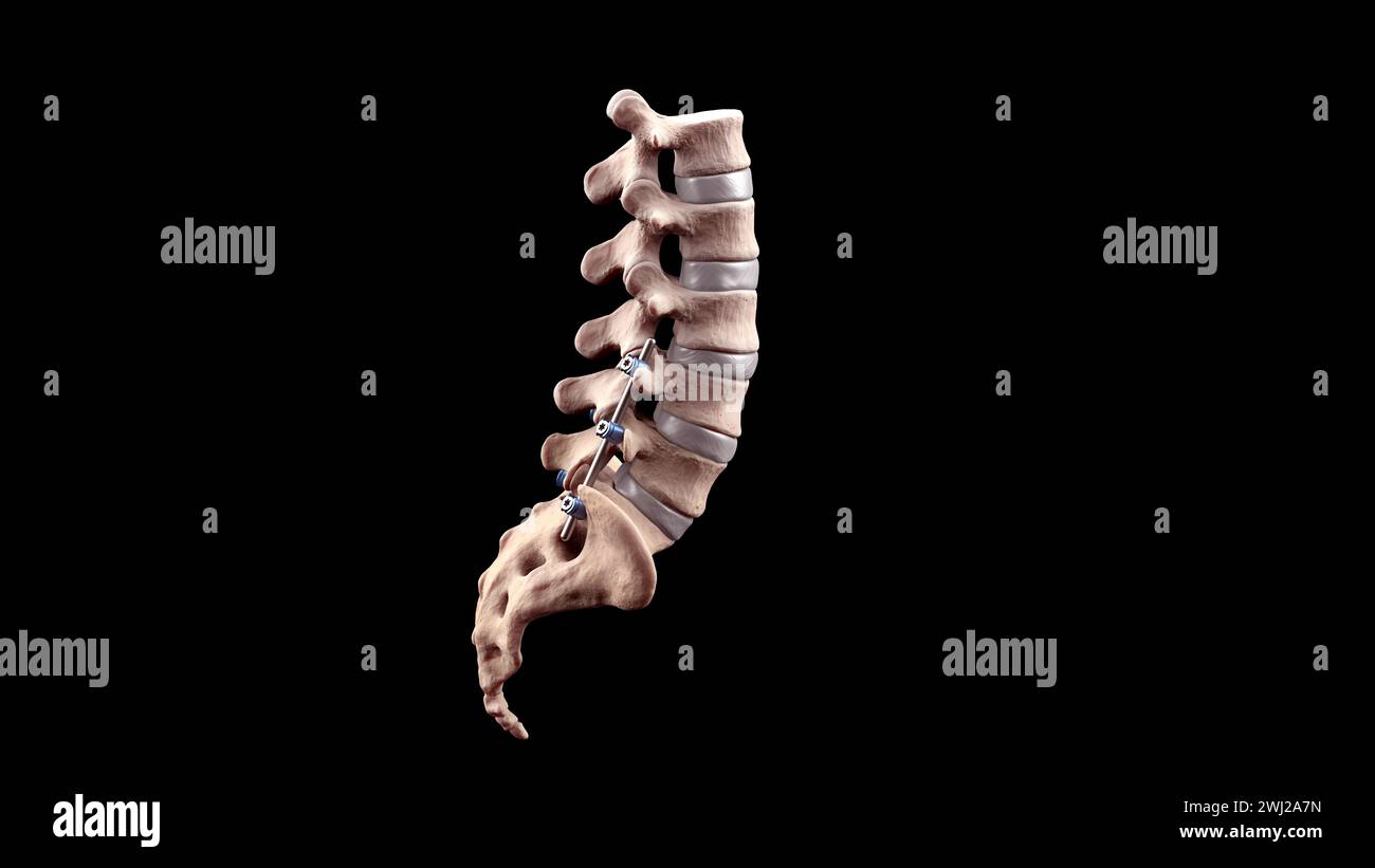 Illustrazione medica 3D della fusione toracica posteriore con viti e aste per pedicle su scheletro umano Foto Stock