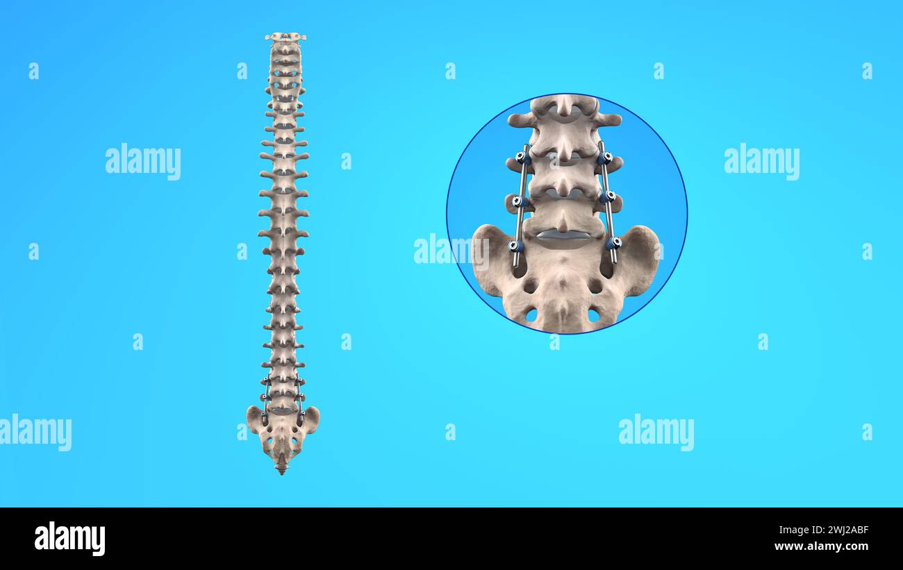 Illustrazione medica 3D della fusione toracica posteriore con viti e aste per pedicle su scheletro umano Foto Stock
