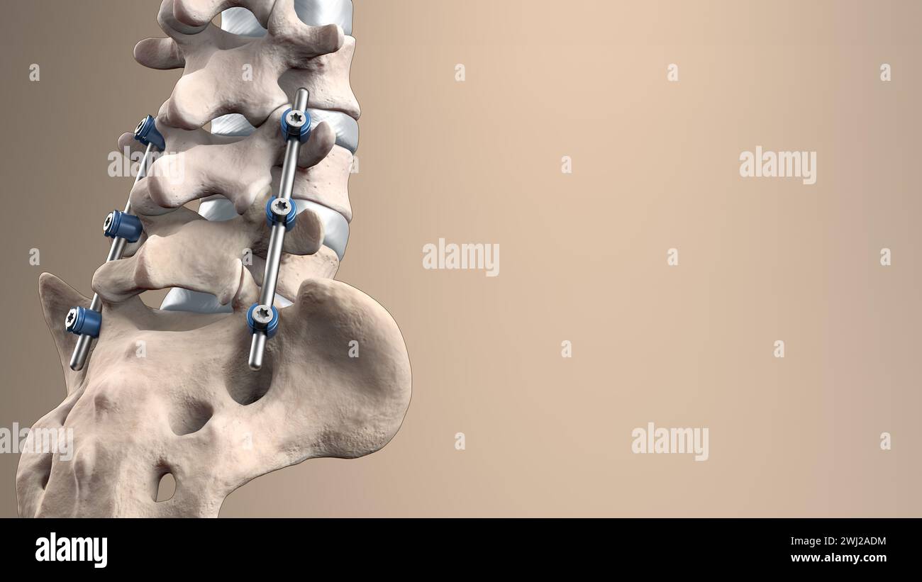 Illustrazione medica 3D della fusione toracica posteriore con viti e aste per pedicle su scheletro umano Foto Stock