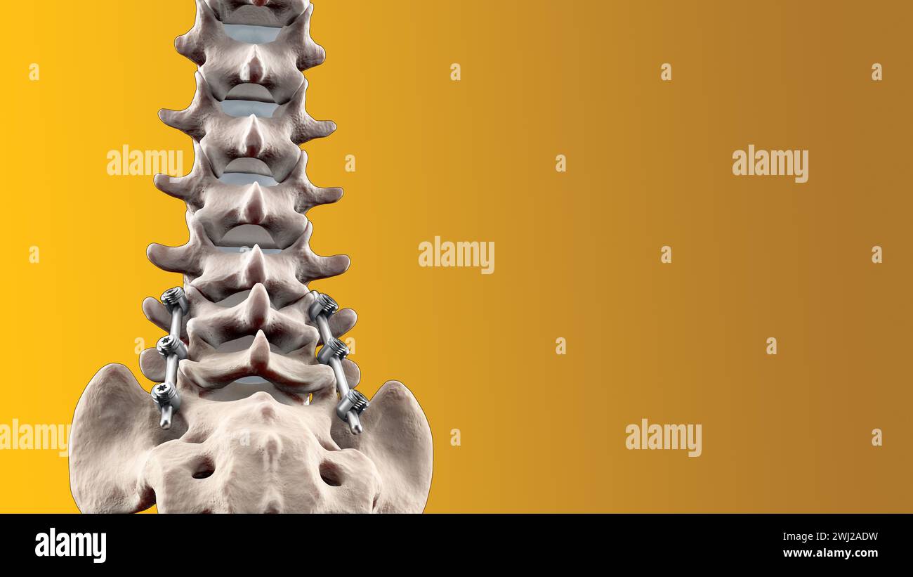 Illustrazione medica 3D della fusione toracica posteriore con viti e aste per pedicle su scheletro umano Foto Stock