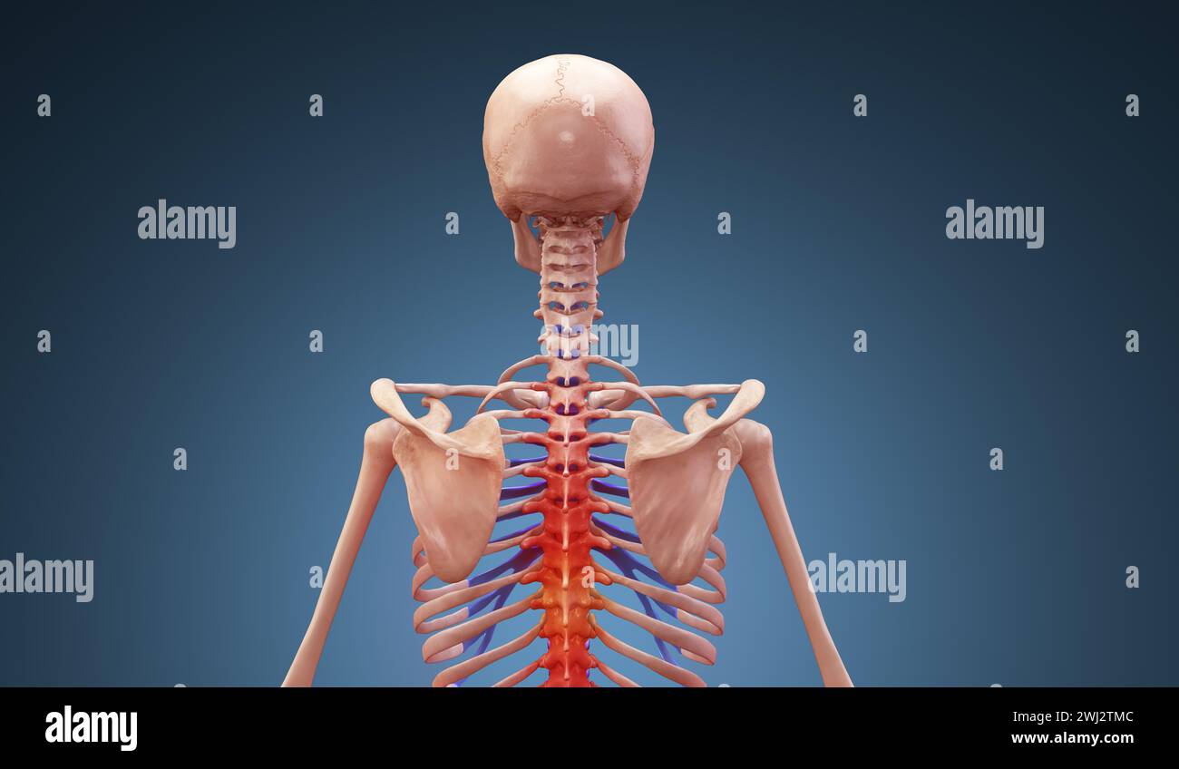 Illustrazione medica 3D della lesione della colonna cervicale sullo scheletro Foto Stock