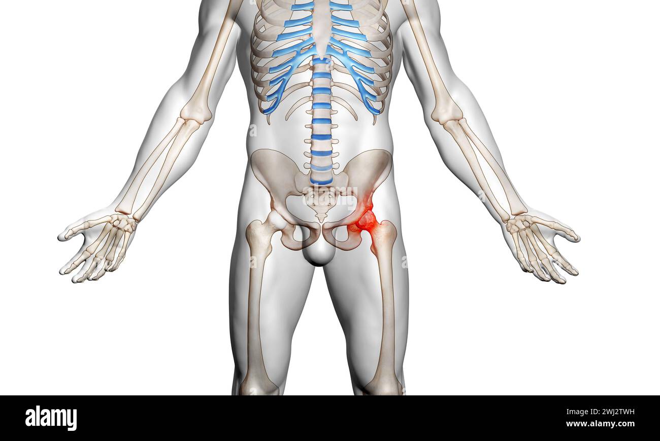 Scheletro con osteoartrite, lesione articolare dell'anca Foto Stock