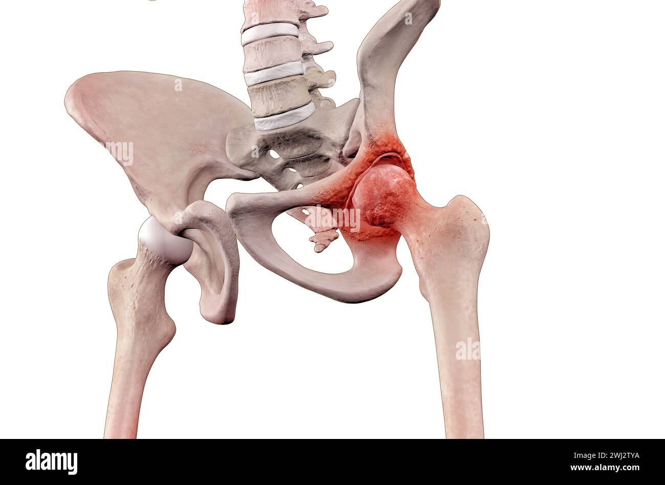 Scheletro con osteoartrite, lesione articolare dell'anca Foto Stock