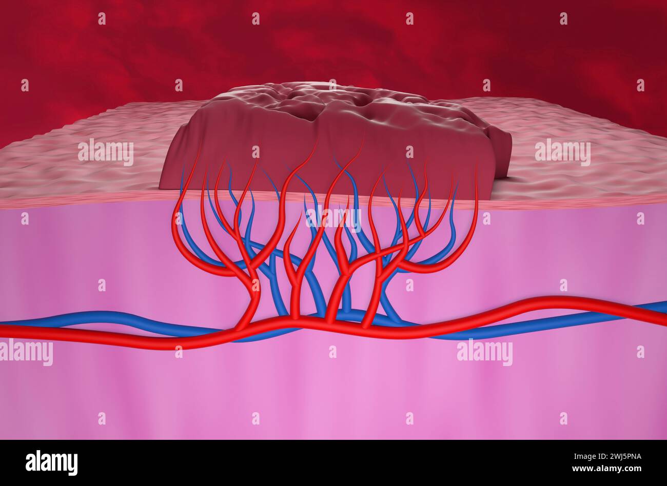 Emangioma tumorale - Vista isometrica illustrazione 3d. Foto Stock