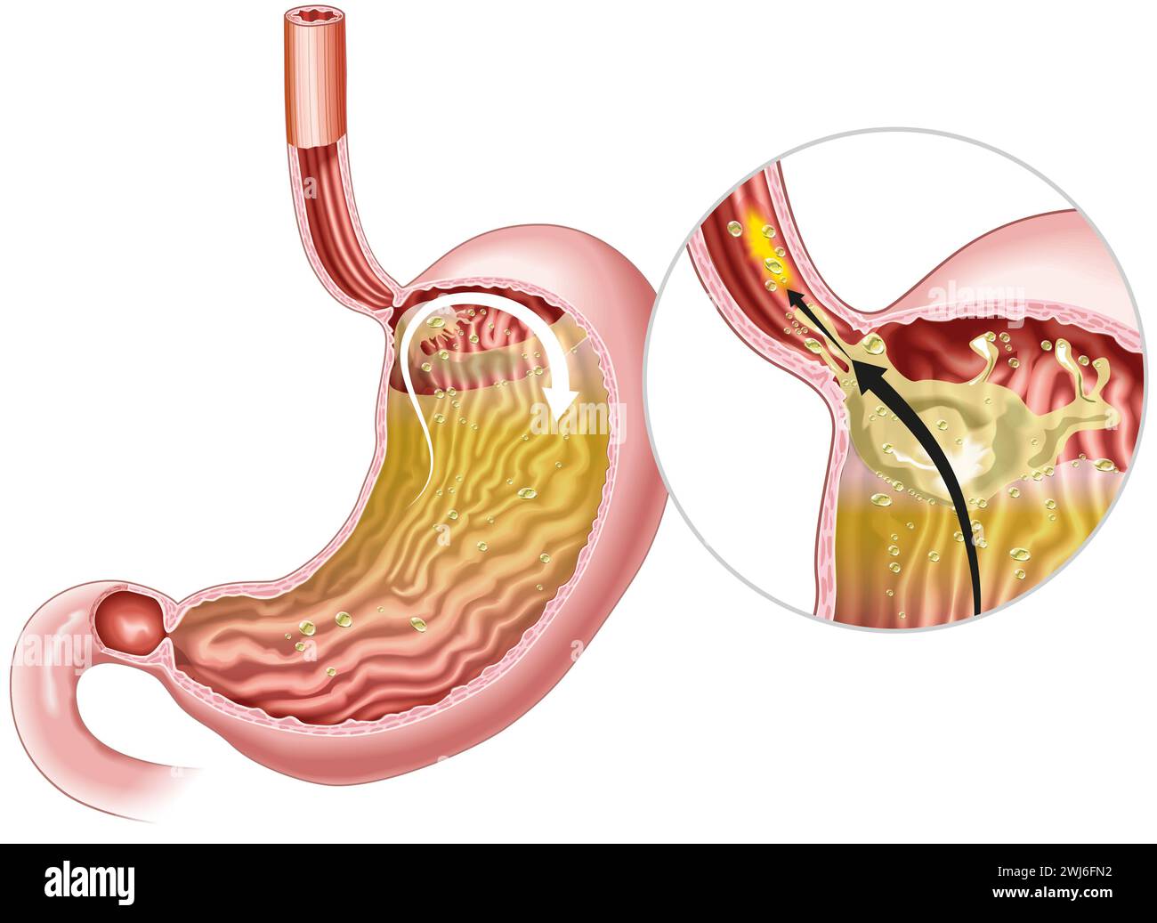 Illustrazione che mostra la malattia da reflusso gastrofageo (GERD) è un disturbo digestivo in cui l'acido dello stomaco rifluisce nell'esofago, causando disagio Foto Stock