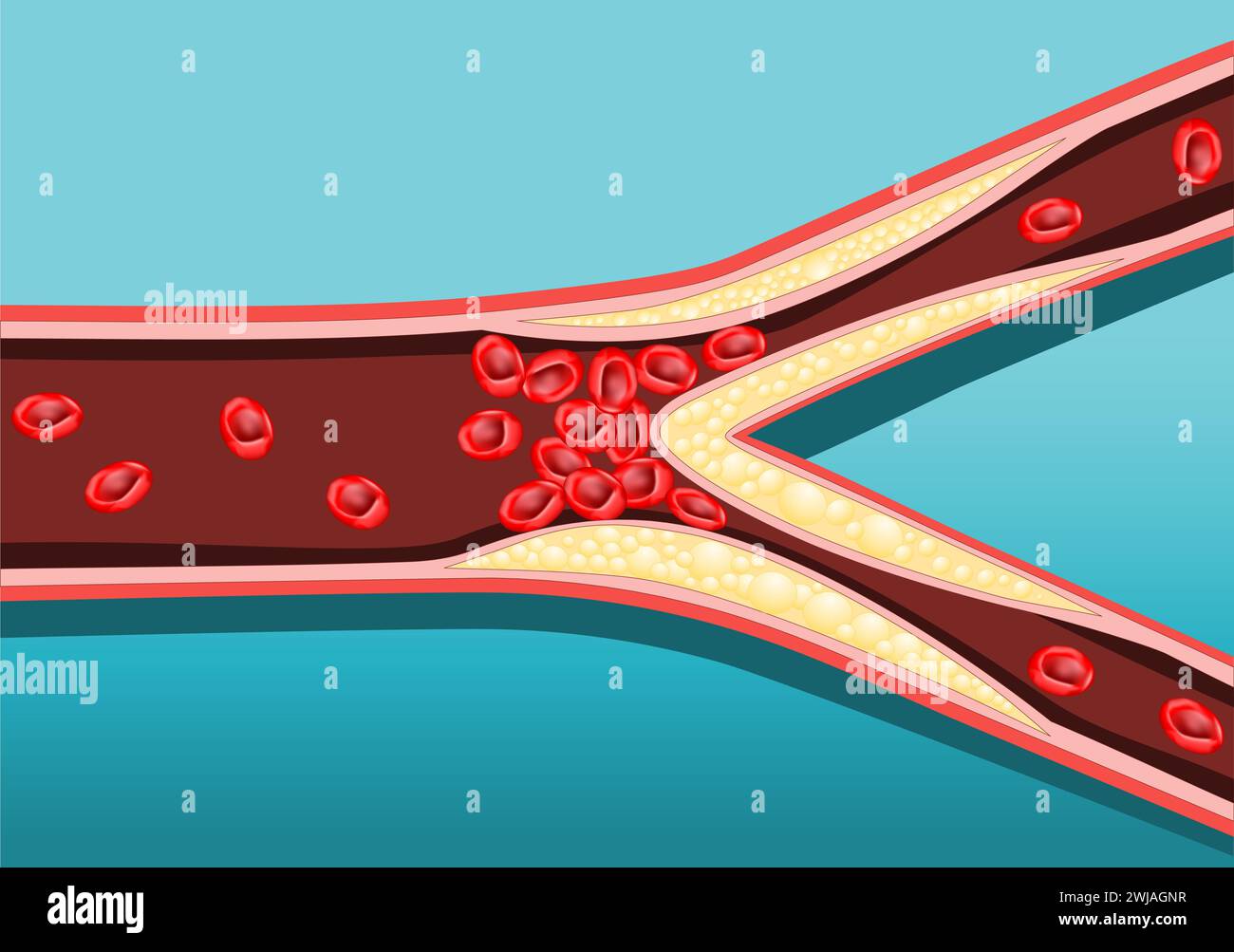 Aterosclerosi. La parete dell'arteria si ispessisce a causa dell'accumulo di calcio, grasso e colesterolo. Riduce l'elasticità dell'arteria. Vettore Illustrazione Vettoriale
