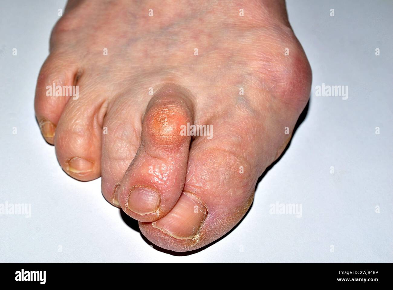 L'immagine mostra un primo piano del piede destro della gamba colpita dalla malattia, l'allux valgus, le dita sono attorcigliate. Foto Stock