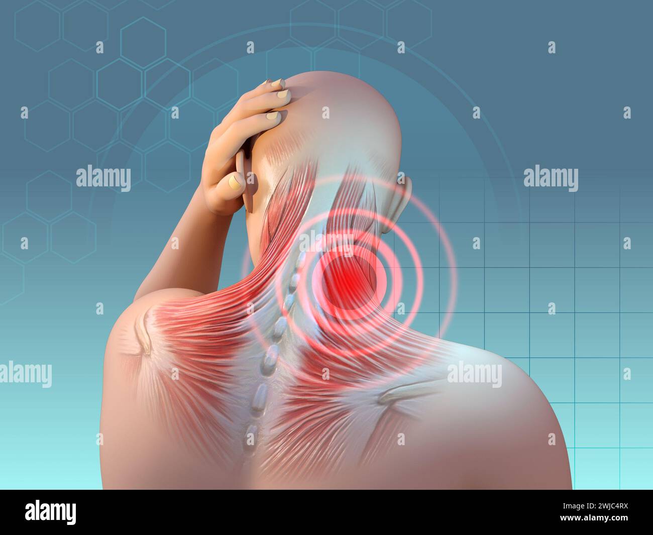 Dolore muscolare nella zona del collo e della spalla. Illustrazione digitale, rendering 3D. Foto Stock