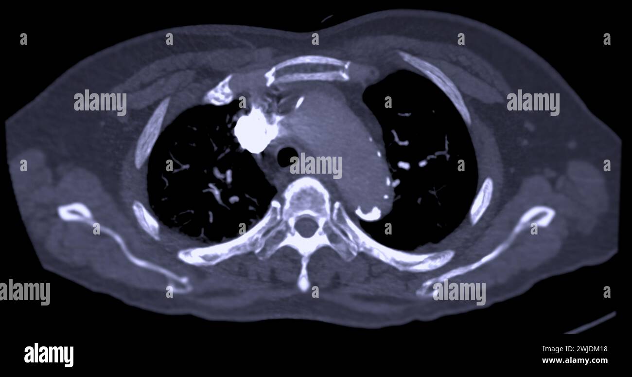 Un'arteria polmonare CTA rivela una vista dettagliata dei vasi sanguigni polmonari, catturando la presenza di embolia polmonare, una condizione in cui una cl ematica Foto Stock