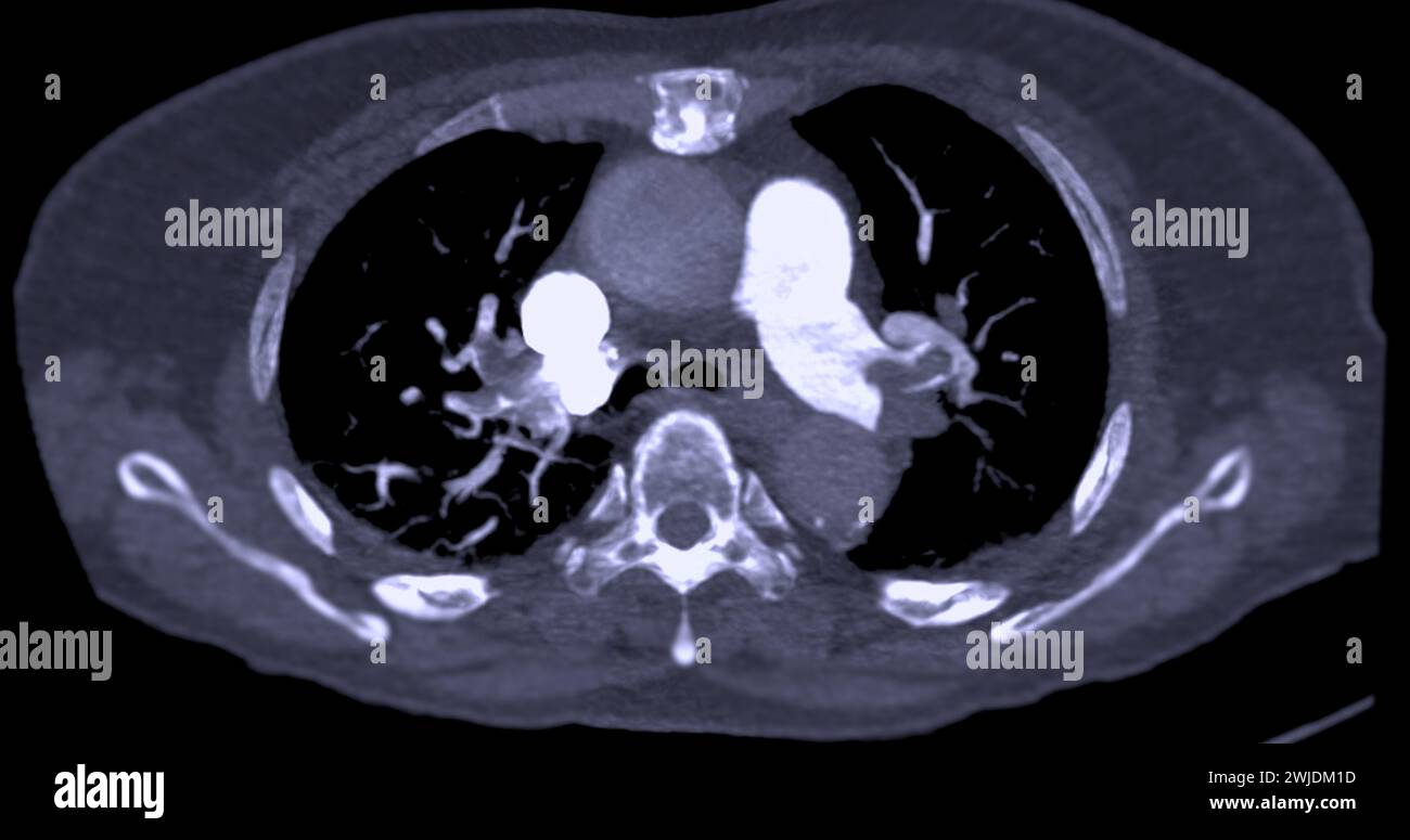 Un'arteria polmonare CTA rivela una vista dettagliata dei vasi sanguigni polmonari, catturando la presenza di embolia polmonare, una condizione in cui una cl ematica Foto Stock