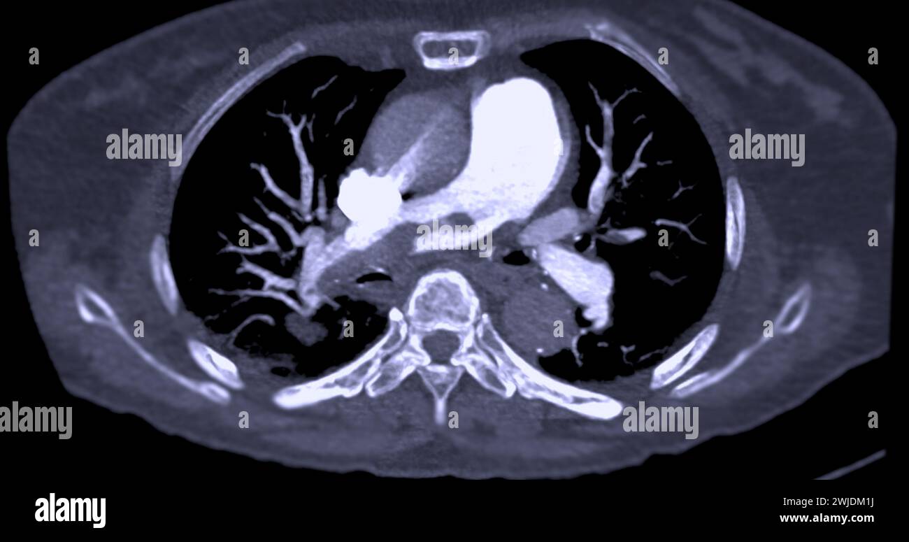 Un'arteria polmonare CTA rivela una vista dettagliata dei vasi sanguigni polmonari, catturando la presenza di embolia polmonare, una condizione in cui una cl ematica Foto Stock