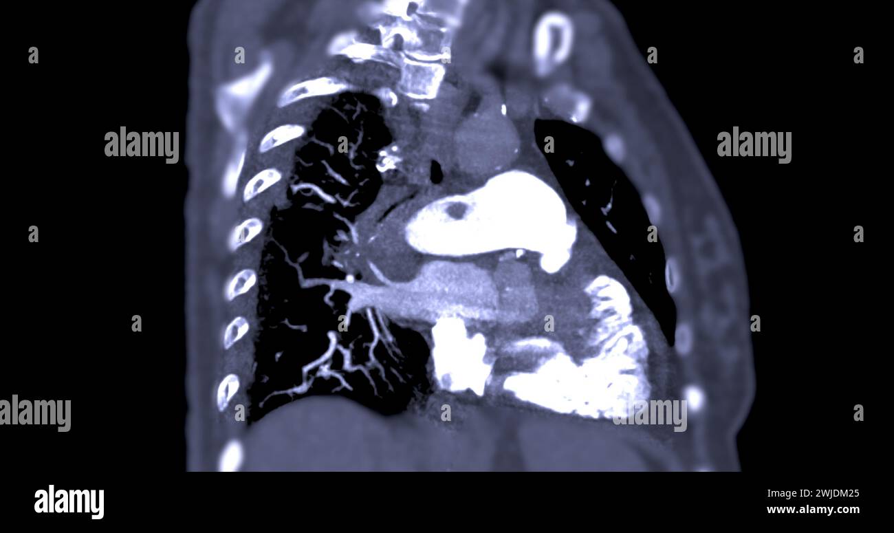 Un'arteria polmonare CTA rivela una vista dettagliata dei vasi sanguigni polmonari, catturando la presenza di embolia polmonare, una condizione in cui una cl ematica Foto Stock