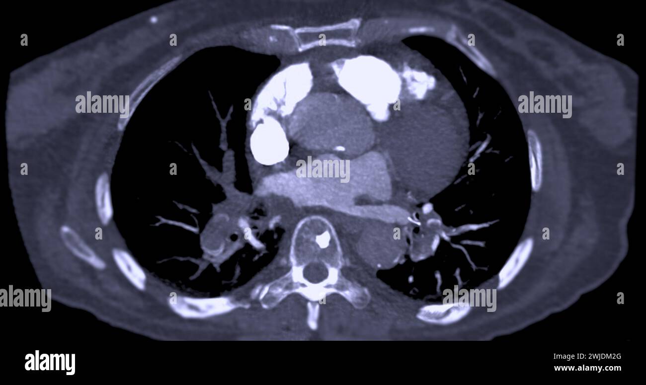 Un'arteria polmonare CTA rivela una vista dettagliata dei vasi sanguigni polmonari, catturando la presenza di embolia polmonare, una condizione in cui una cl ematica Foto Stock