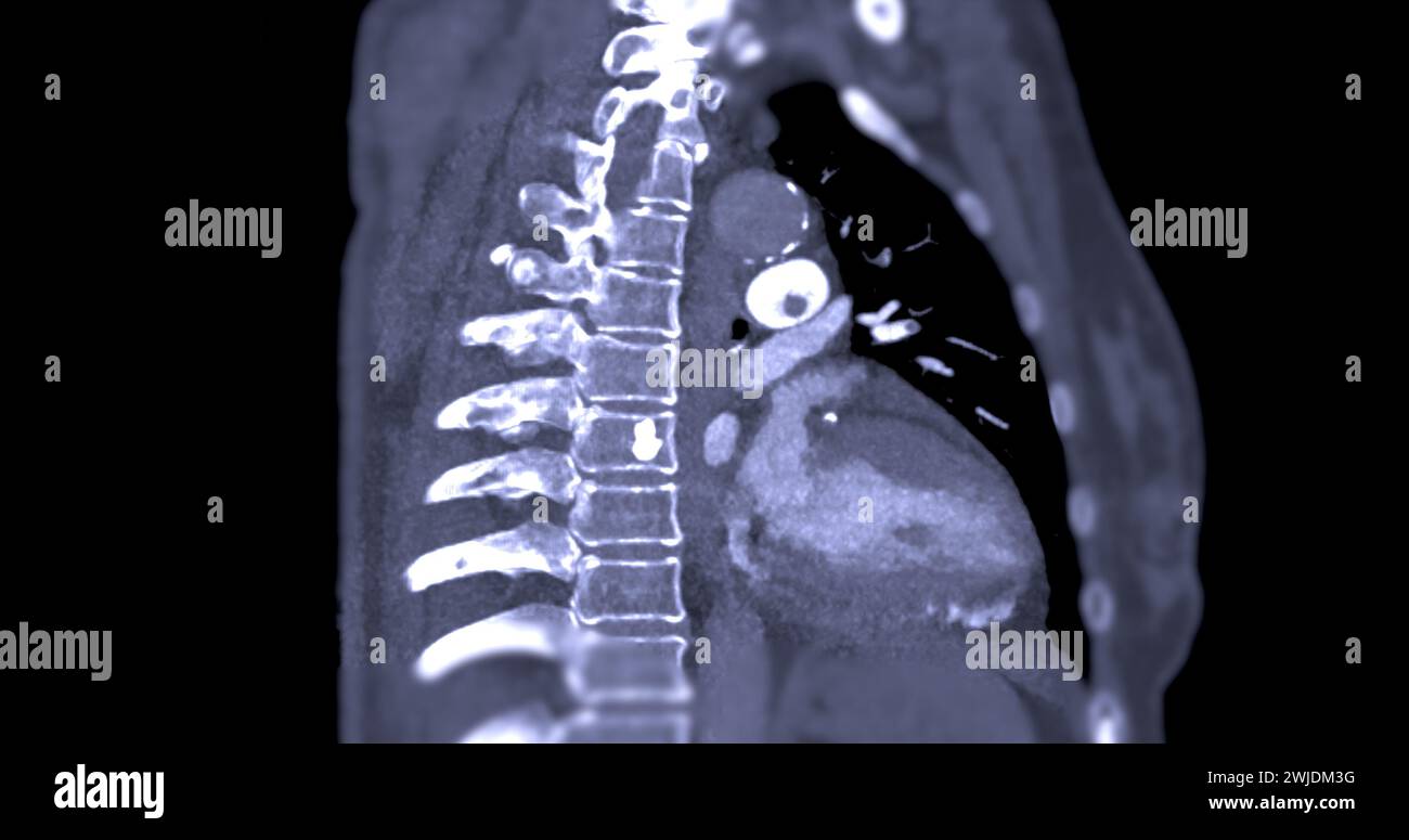 Un'arteria polmonare CTA rivela una vista dettagliata dei vasi sanguigni polmonari, catturando la presenza di embolia polmonare, una condizione in cui una cl ematica Foto Stock