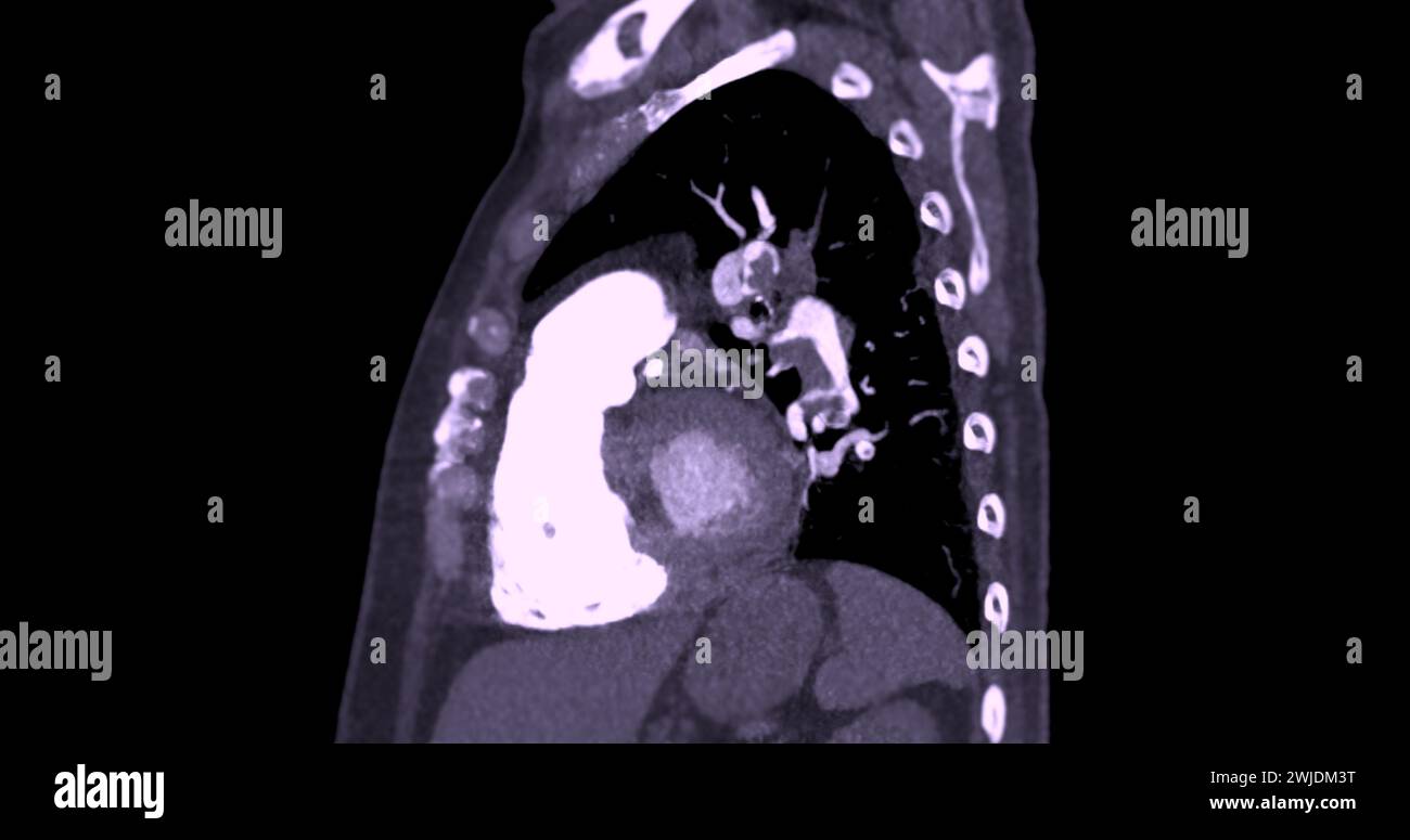 Un'arteria polmonare CTA rivela una vista dettagliata dei vasi sanguigni polmonari, catturando la presenza di embolia polmonare, una condizione in cui una cl ematica Foto Stock